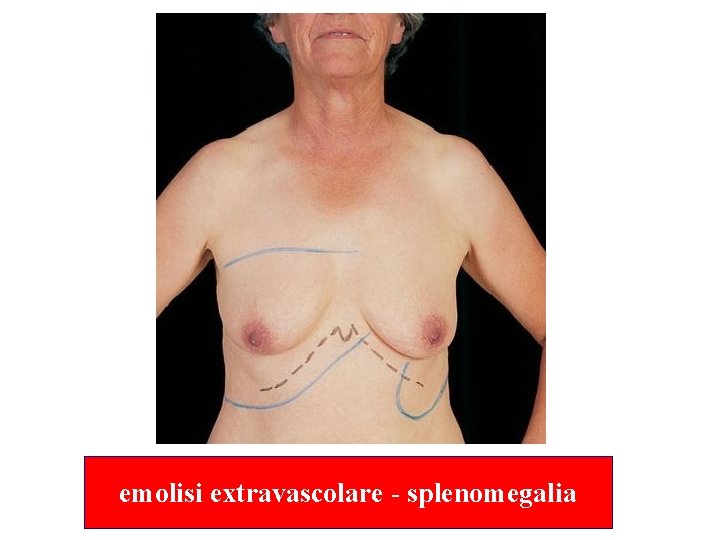 emolisi extravascolare - splenomegalia 