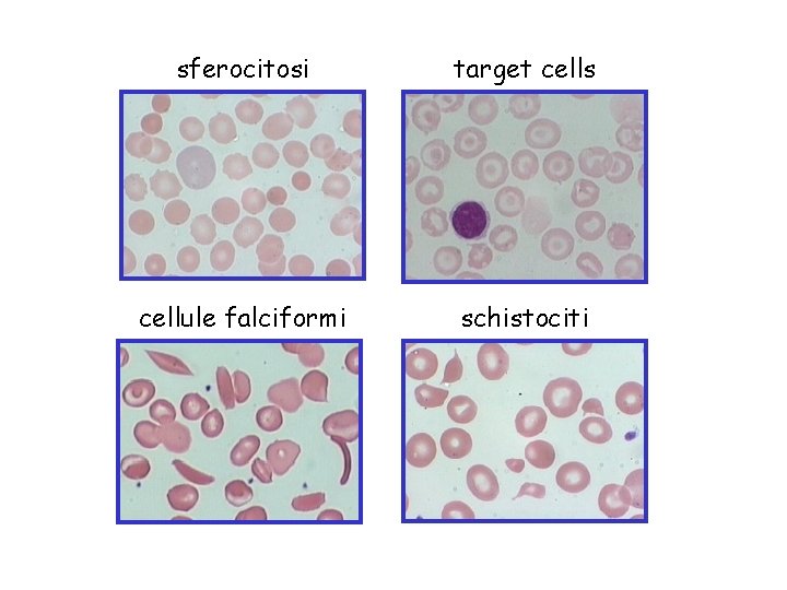 sferocitosi target cells cellule falciformi schistociti 