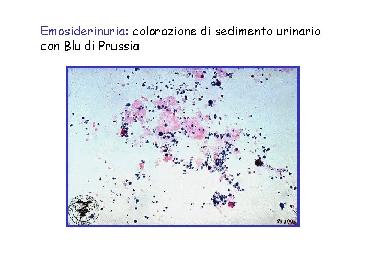Emosiderinuria: colorazione di sedimento urinario con Blu di Prussia 