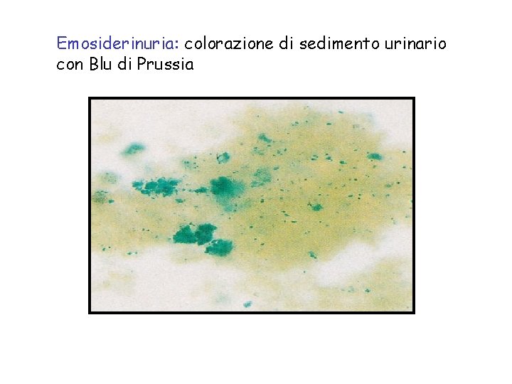 Emosiderinuria: colorazione di sedimento urinario con Blu di Prussia 