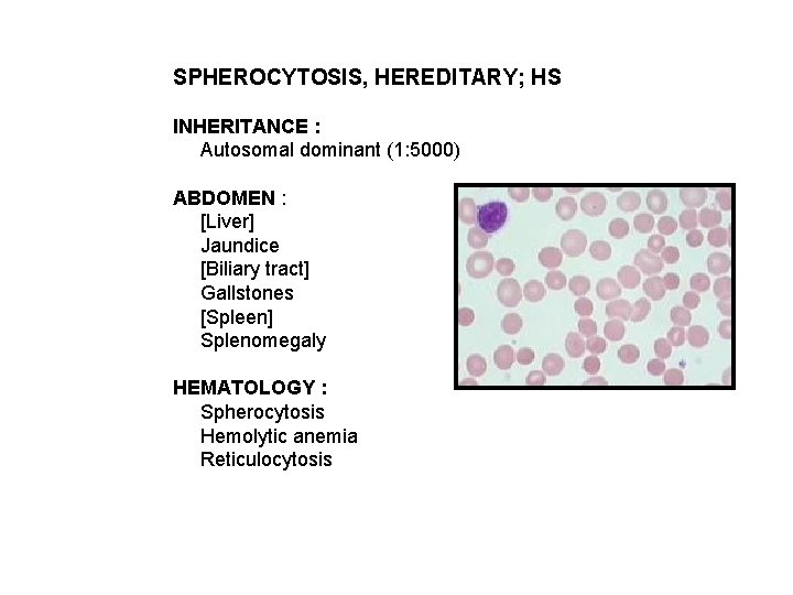 SPHEROCYTOSIS, HEREDITARY; HS INHERITANCE : Autosomal dominant (1: 5000) ABDOMEN : [Liver] Jaundice [Biliary