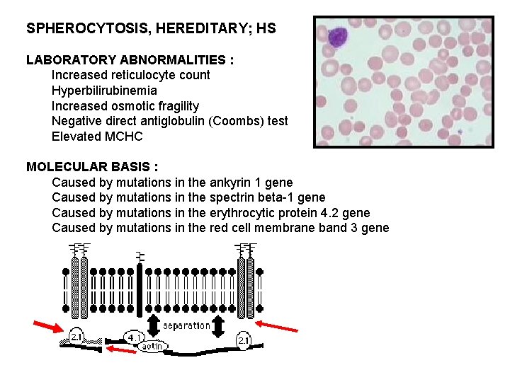 SPHEROCYTOSIS, HEREDITARY; HS LABORATORY ABNORMALITIES : Increased reticulocyte count Hyperbilirubinemia Increased osmotic fragility Negative