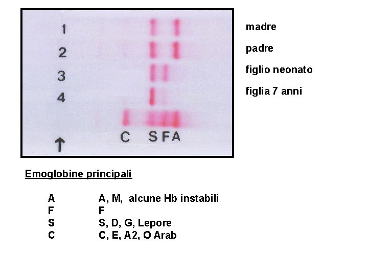 madre padre figlio neonato figlia 7 anni Emoglobine principali A F S C A,