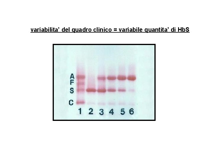 variabilita’ del quadro clinico = variabile quantita’ di Hb. S 