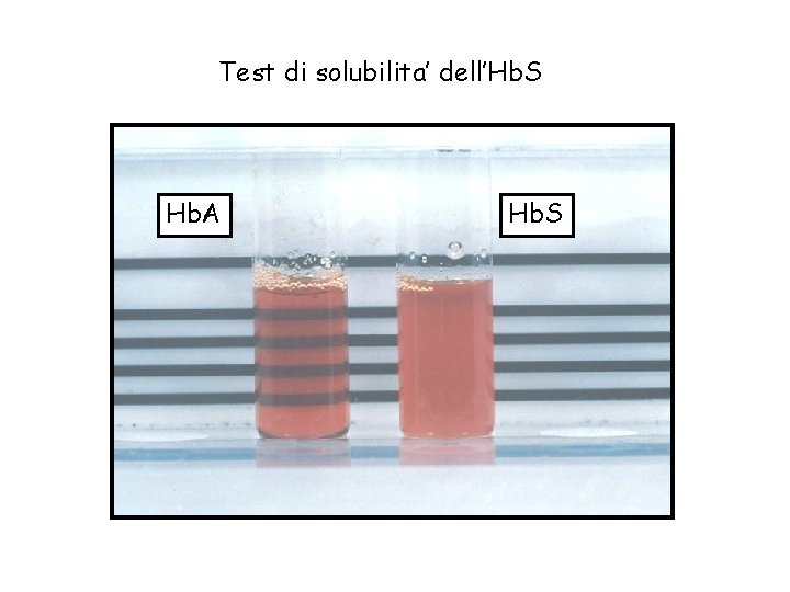 Test di solubilita’ dell’Hb. S Hb. A Hb. S 