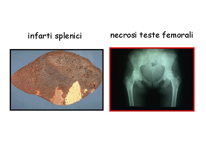 infarti splenici necrosi teste femorali 