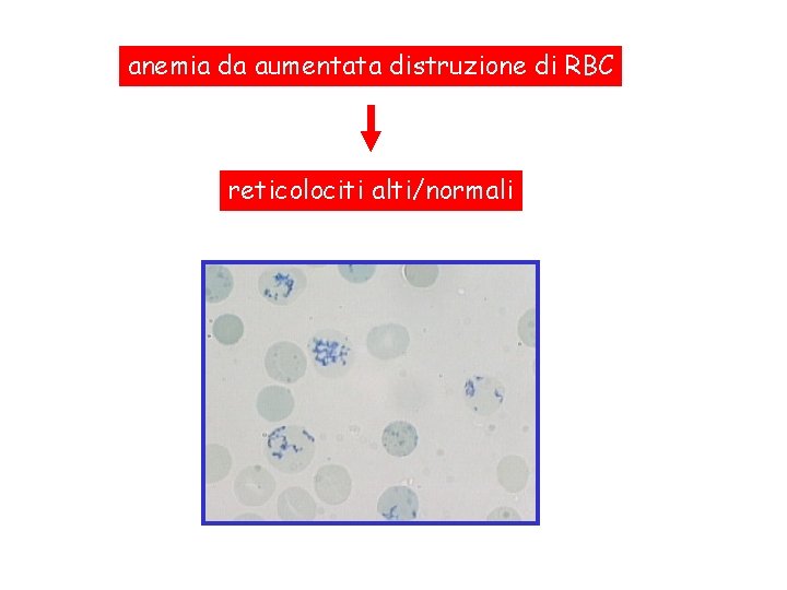 anemia da aumentata distruzione di RBC reticolociti alti/normali 