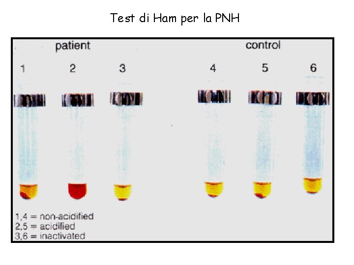 Test di Ham per la PNH 