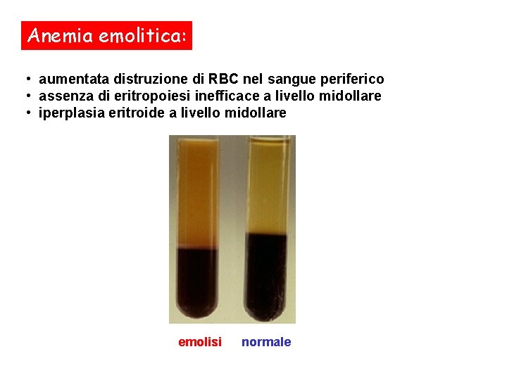 Anemia emolitica: • aumentata distruzione di RBC nel sangue periferico • assenza di eritropoiesi