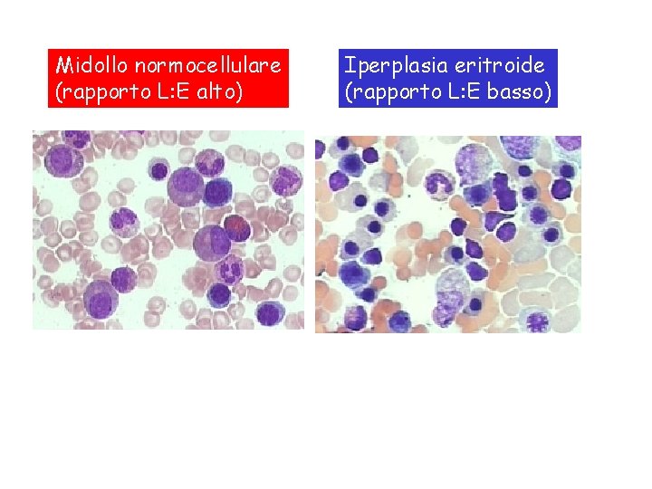 Midollo normocellulare (rapporto L: E alto) Iperplasia eritroide (rapporto L: E basso) 