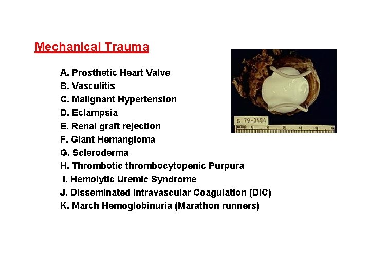 Mechanical Trauma A. Prosthetic Heart Valve B. Vasculitis C. Malignant Hypertension D. Eclampsia E.