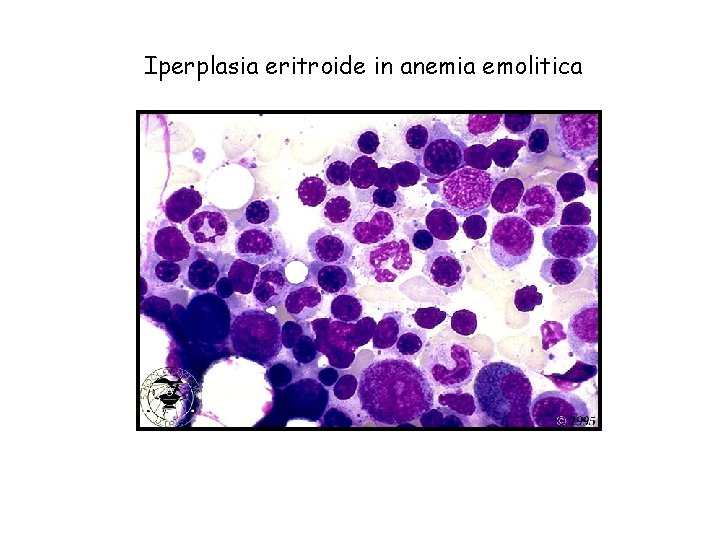 Iperplasia eritroide in anemia emolitica 