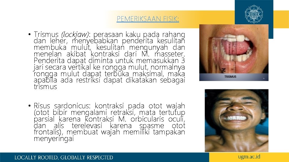 PEMERIKSAAN FISIK: • Trismus (lockjaw): perasaan kaku pada rahang dan leher, menyebabkan penderita kesulitan