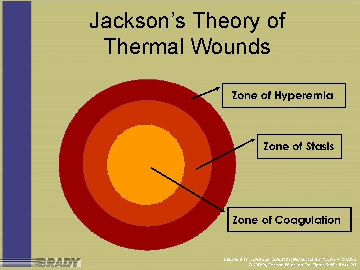 Jackson’s Theory of Thermal Wounds Zone of Hyperemia Zone of Stasis Zone of Coagulation