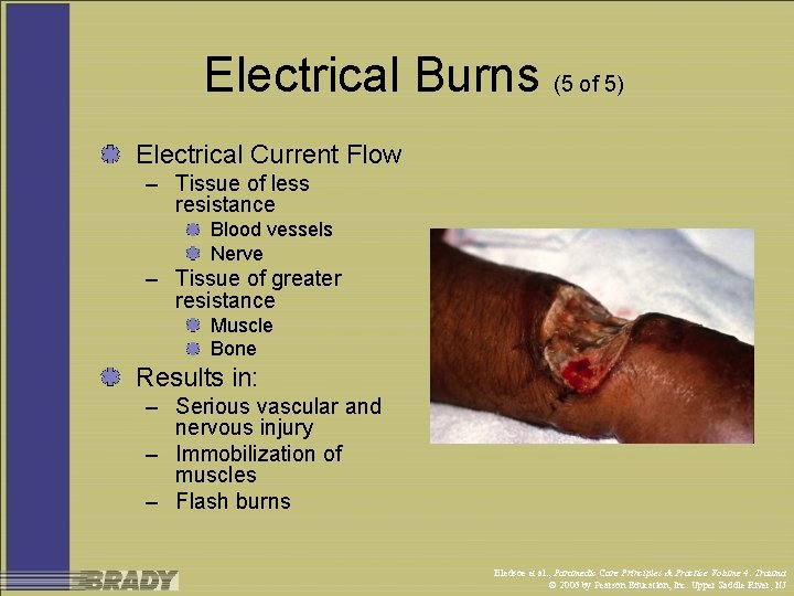 Electrical Burns (5 of 5) Electrical Current Flow – Tissue of less resistance Blood