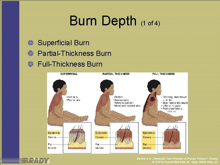 Burn Depth (1 of 4) Superficial Burn Partial-Thickness Burn Full-Thickness Burn Bledsoe et al.