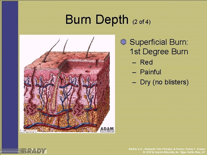 Burn Depth (2 of 4) Superficial Burn: 1 st Degree Burn – Red –