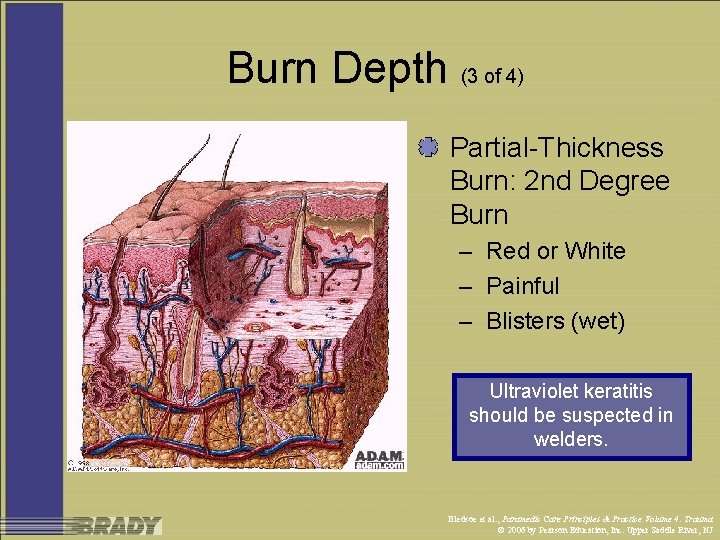 Burn Depth (3 of 4) Partial-Thickness Burn: 2 nd Degree Burn – Red or
