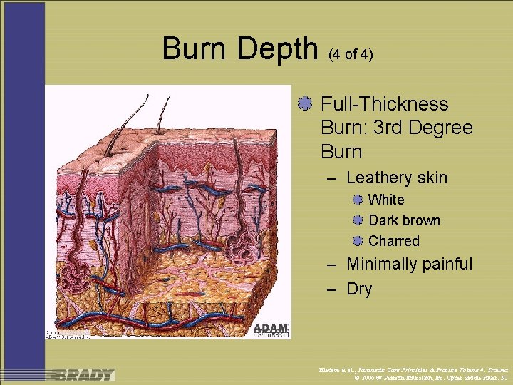 Burn Depth (4 of 4) Full-Thickness Burn: 3 rd Degree Burn – Leathery skin