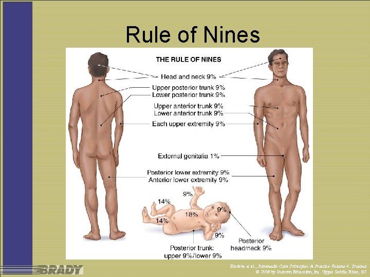 Rule of Nines Bledsoe et al. , Paramedic Care Principles & Practice Volume 4: