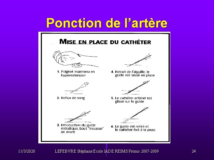 Ponction de l’artère 11/3/2020 LEFEBVRE Stéphane Ecole IADE REIMS Promo 2007 -2009 24 