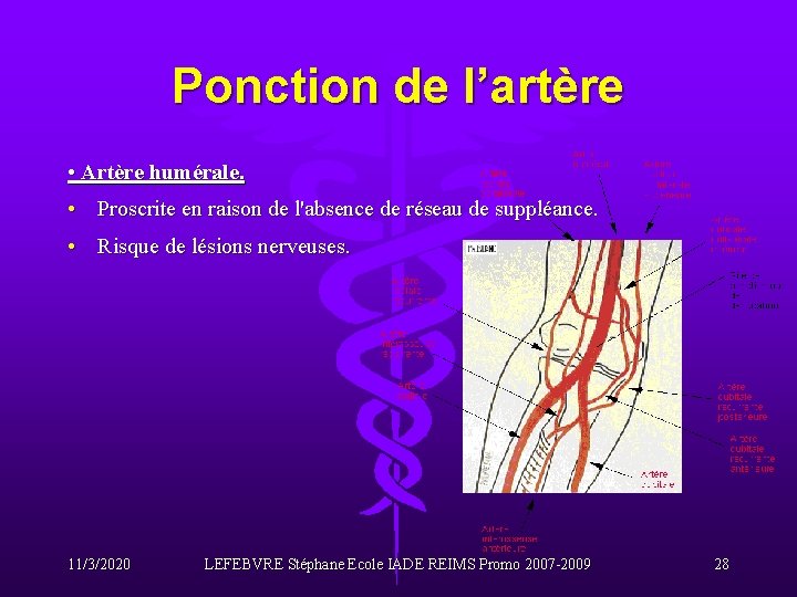 Ponction de l’artère • Artère humérale. • Proscrite en raison de l'absence de réseau