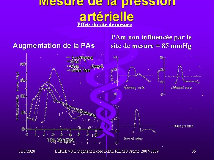 Mesure de la pression artérielle Effets du site de mesure Augmentation de la PAs