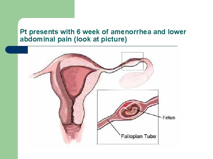 Pt presents with 6 week of amenorrhea and lower abdominal pain (look at picture)