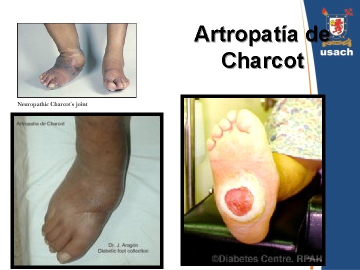 Artropatía de Charcot 