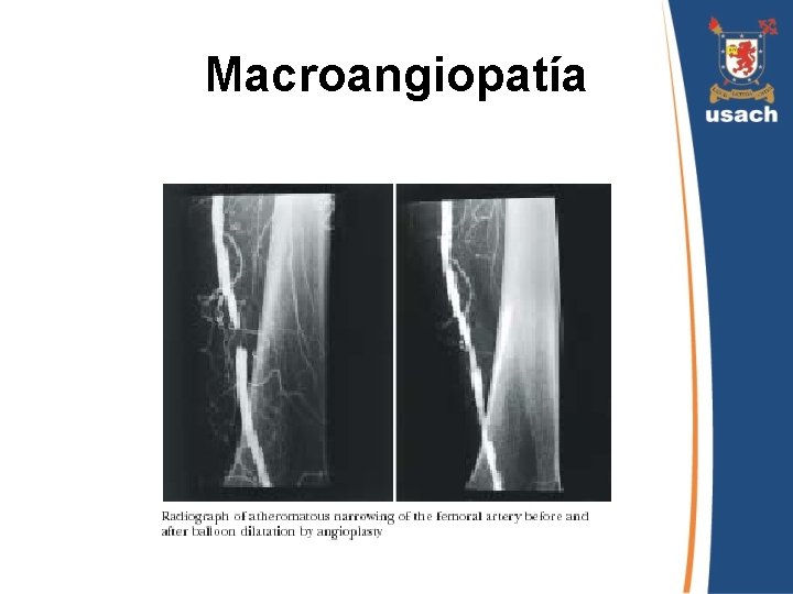 Macroangiopatía 