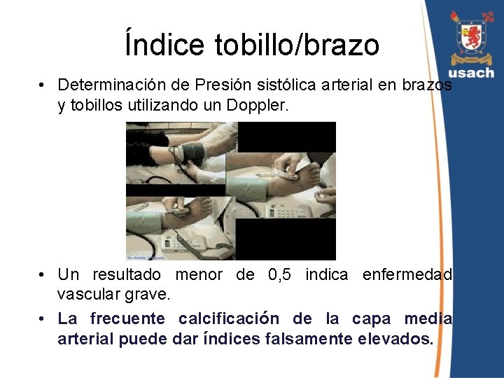 Índice tobillo/brazo • Determinación de Presión sistólica arterial en brazos y tobillos utilizando un