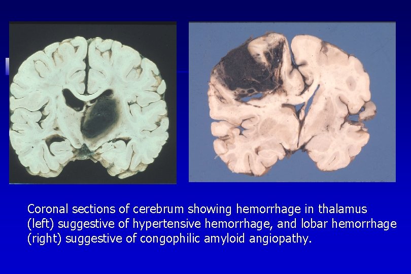 Coronal sections of cerebrum showing hemorrhage in thalamus (left) suggestive of hypertensive hemorrhage, and