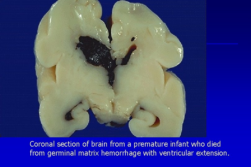 Coronal section of brain from a premature infant who died from germinal matrix hemorrhage