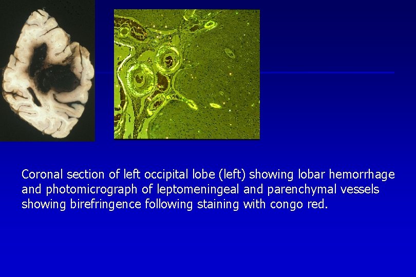 Coronal section of left occipital lobe (left) showing lobar hemorrhage and photomicrograph of leptomeningeal
