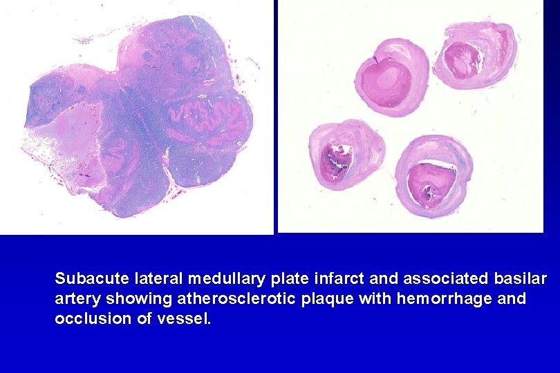 Subacute lateral medullary plate infarct and associated basilar artery showing atherosclerotic plaque with hemorrhage