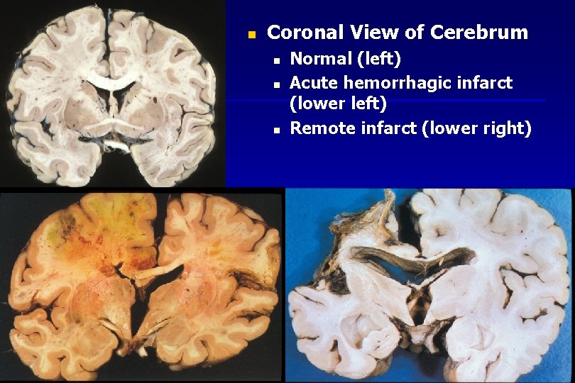 n Coronal View of Cerebrum n n n Normal (left) Acute hemorrhagic infarct (lower