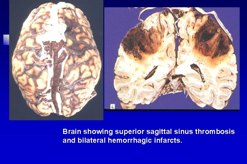 Brain showing superior sagittal sinus thrombosis and bilateral hemorrhagic infarcts. 