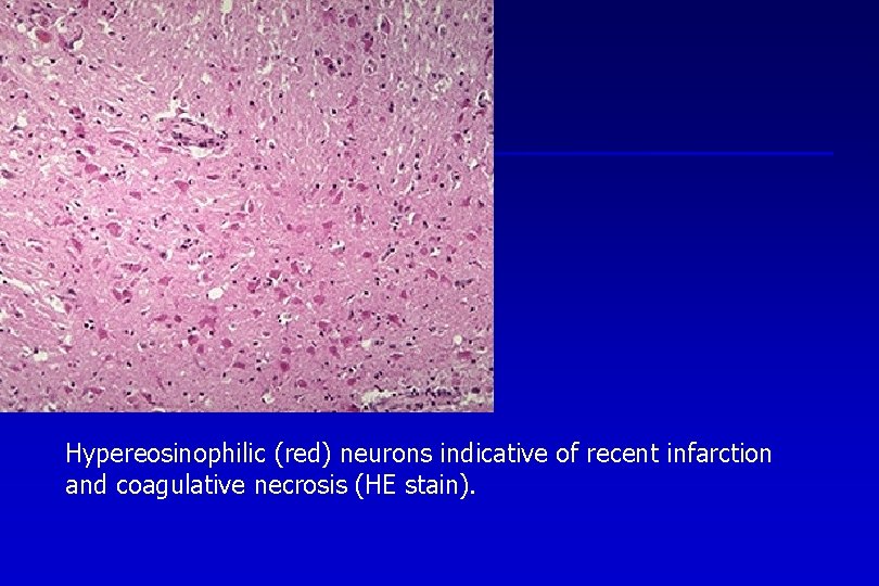 Hypereosinophilic (red) neurons indicative of recent infarction and coagulative necrosis (HE stain). 