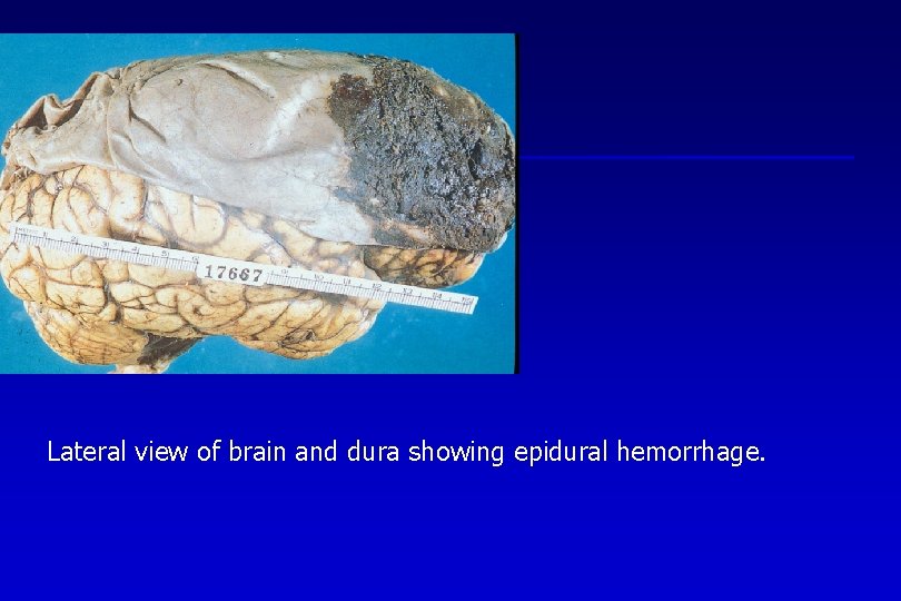 Lateral view of brain and dura showing epidural hemorrhage. 