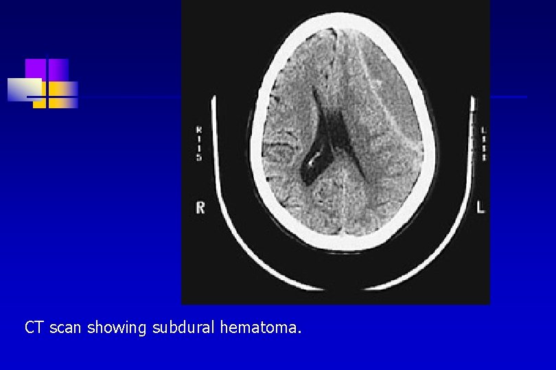 CT scan showing subdural hematoma. 