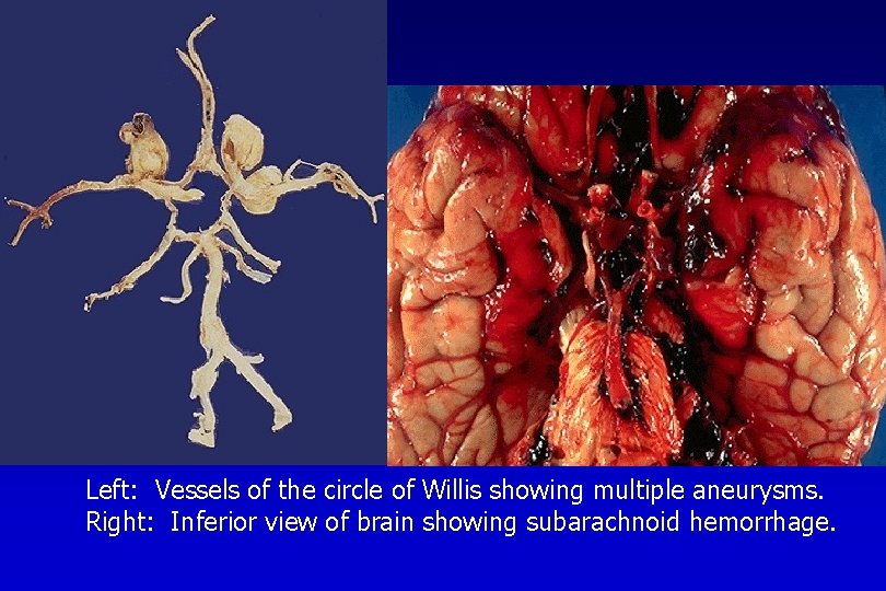 Left: Vessels of the circle of Willis showing multiple aneurysms. Right: Inferior view of