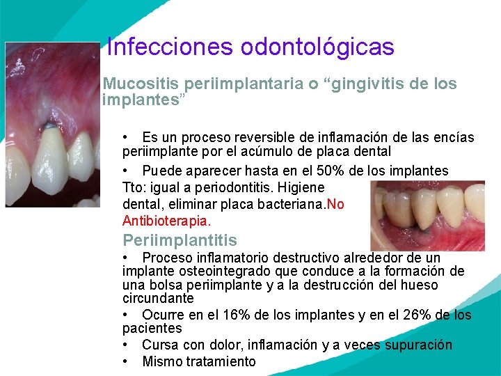 Infecciones odontológicas Mucositis periimplantaria o “gingivitis de los implantes” • Es un proceso reversible