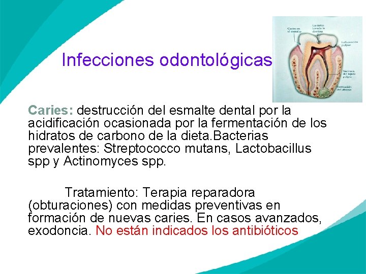 Infecciones odontológicas Caries: destrucción del esmalte dental por la acidificación ocasionada por la fermentación