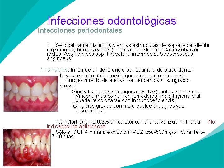 Infecciones odontológicas Infecciones periodontales • Se localizan en la encía y en las estructuras