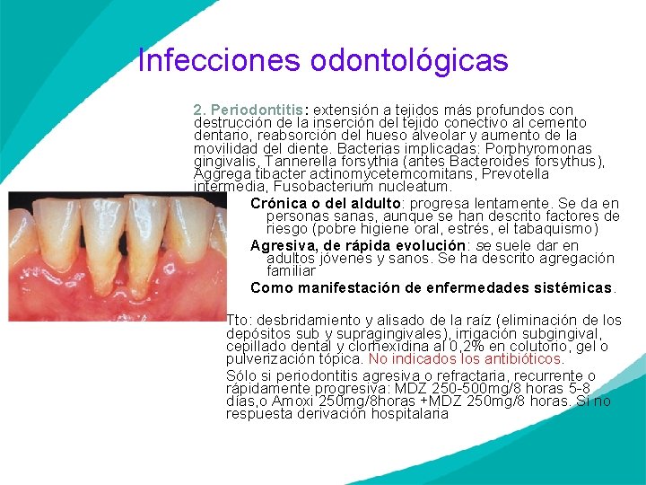 Infecciones odontológicas 2. Periodontitis: extensión a tejidos más profundos con destrucción de la inserción