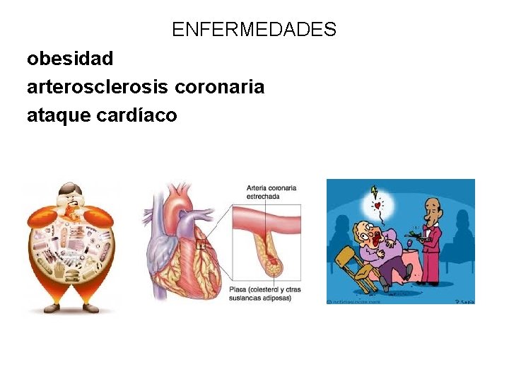 ENFERMEDADES obesidad arterosclerosis coronaria ataque cardíaco 