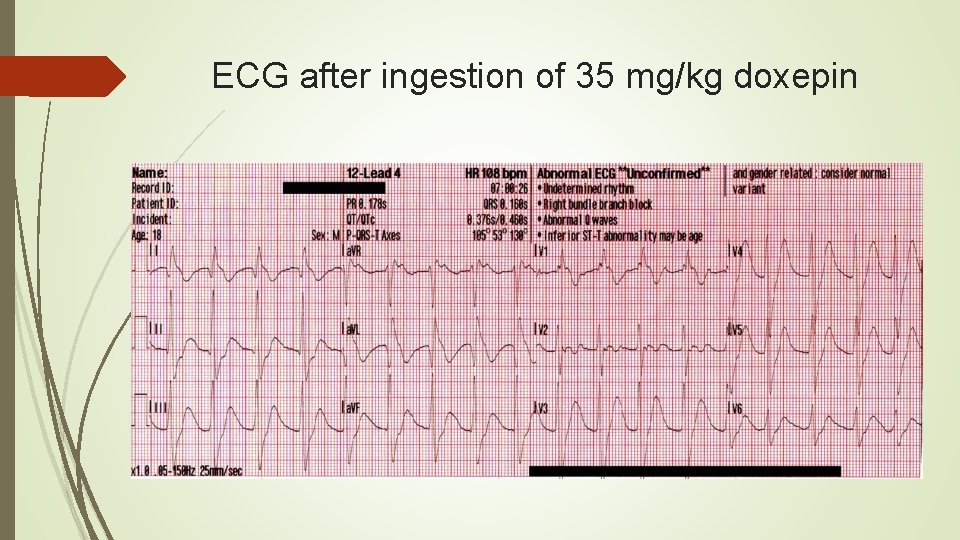ECG after ingestion of 35 mg/kg doxepin 