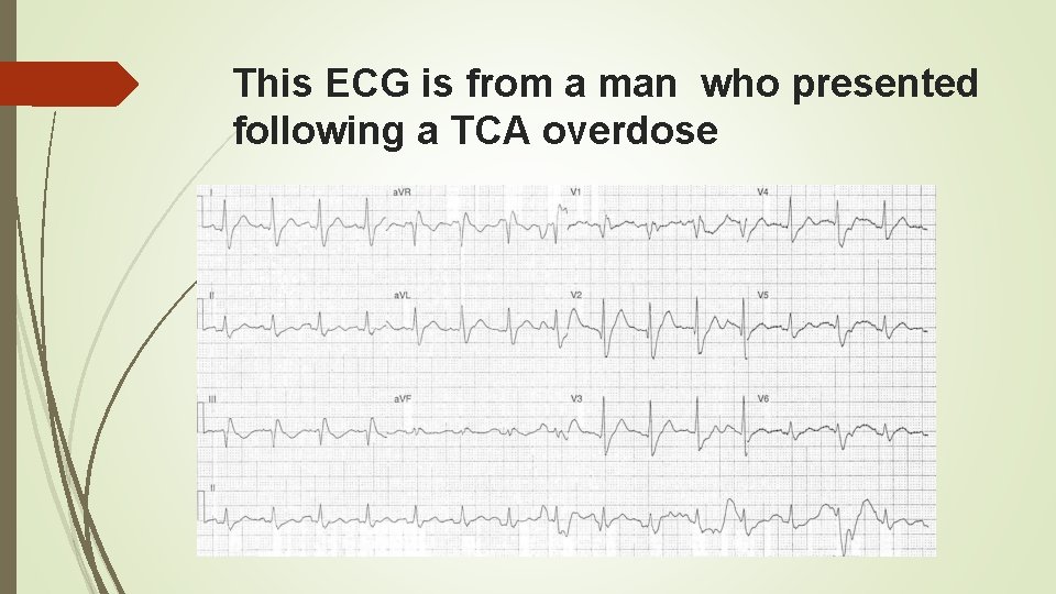 This ECG is from a man who presented following a TCA overdose 