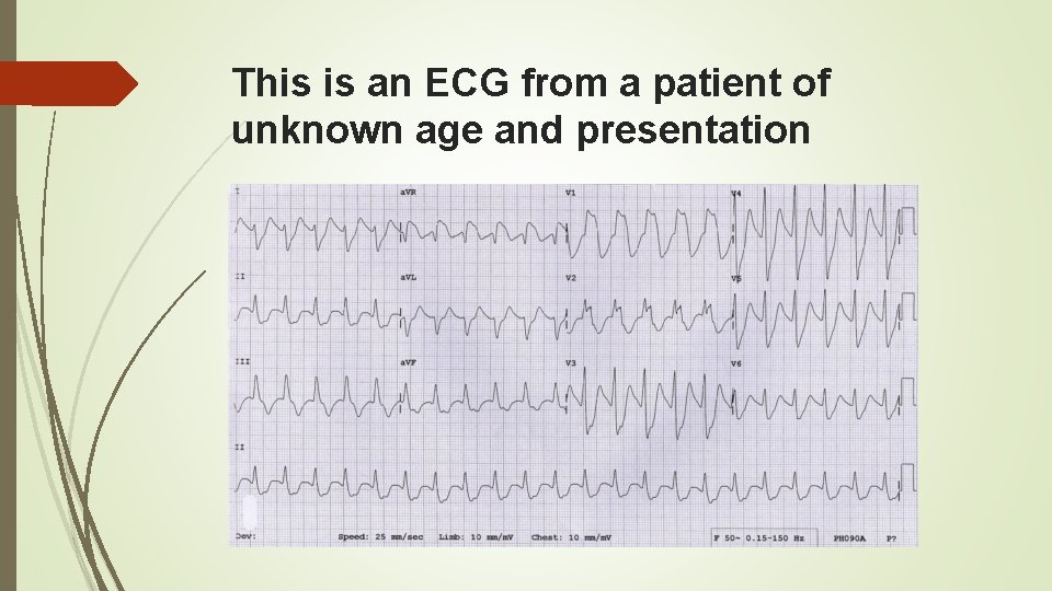 This is an ECG from a patient of unknown age and presentation 