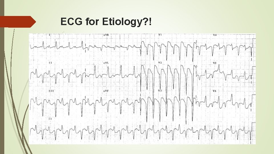 ECG for Etiology? ! 